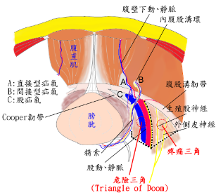 laparoscopic anatomy of inguinal hernia